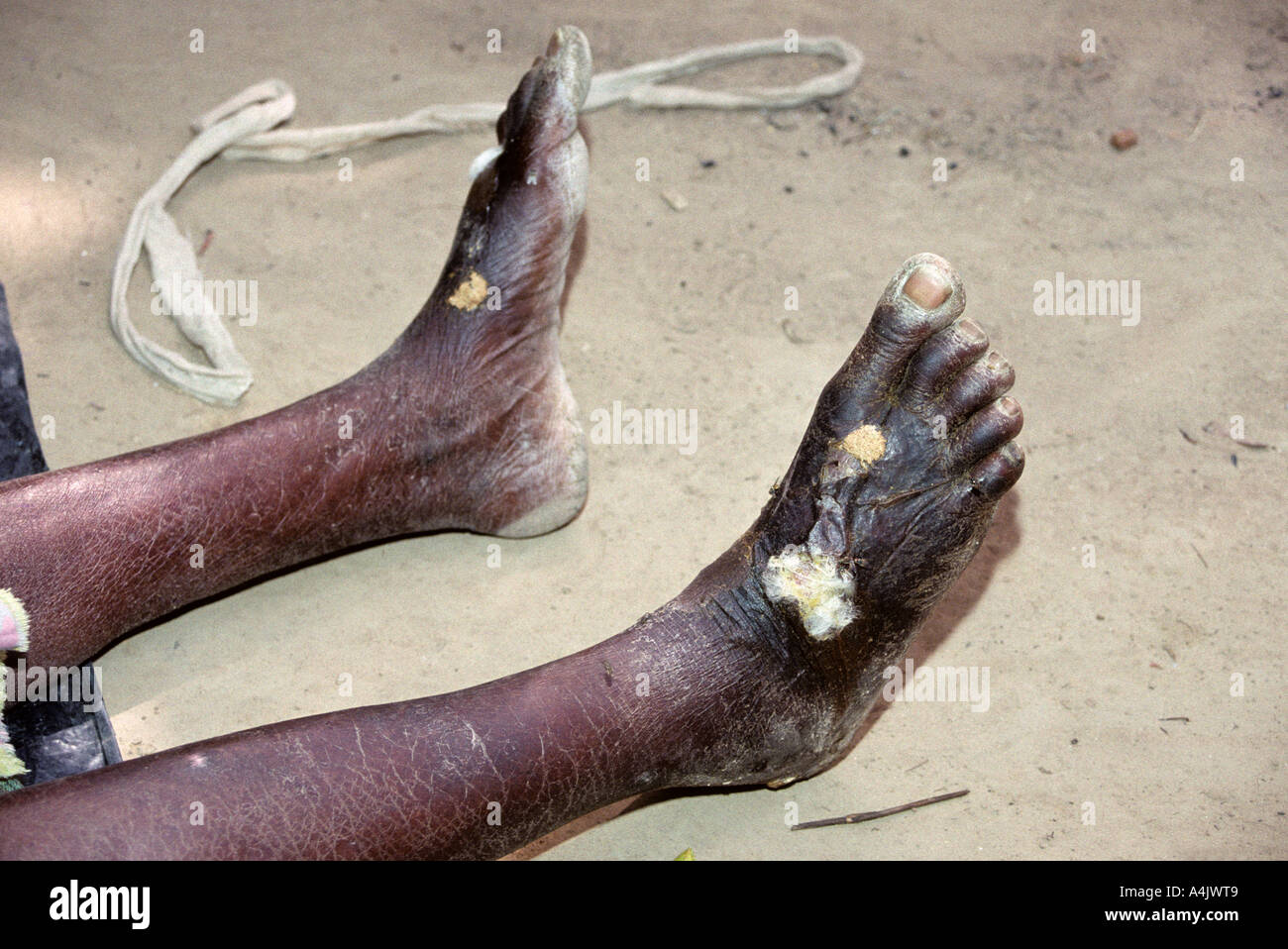 Yorobodi, Ivory Coast, Cote d'Ivoire, Africa. Sores healing after Guinea worm extraction.  208.11 Stock Photo
