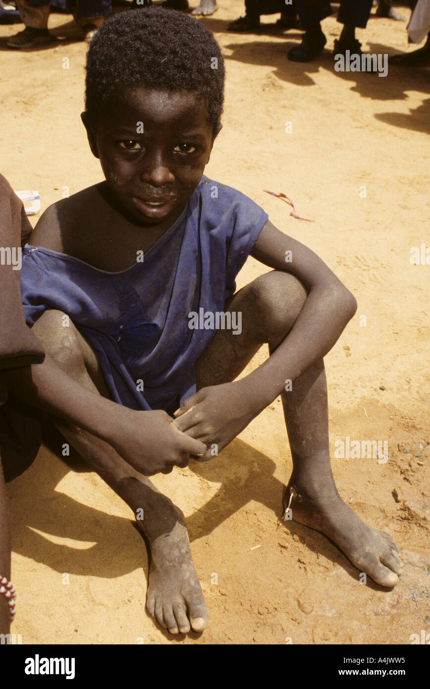 Guinea Worm Emerging from Boy's Ankle, Niger. Stock Photo