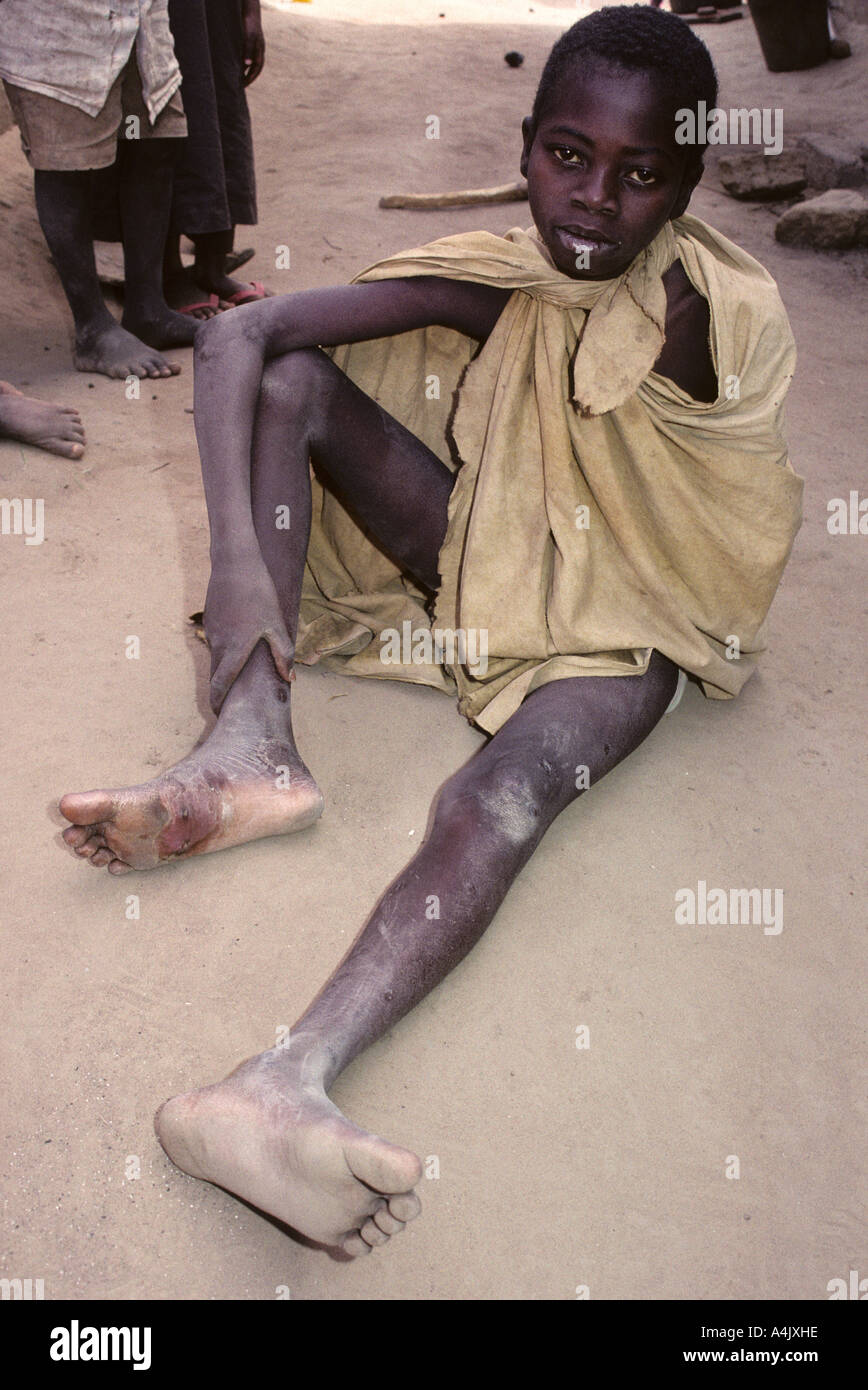 Boy Showing Healing Foot where Guinea Worm has Exited the Foot.  Ivory Coast, Cote d'Ivoire. Stock Photo