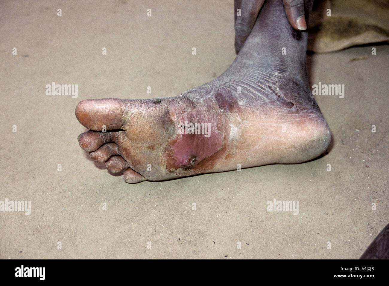 Healing Secondary Infection Where Guinea Worm has Exited. Stock Photo