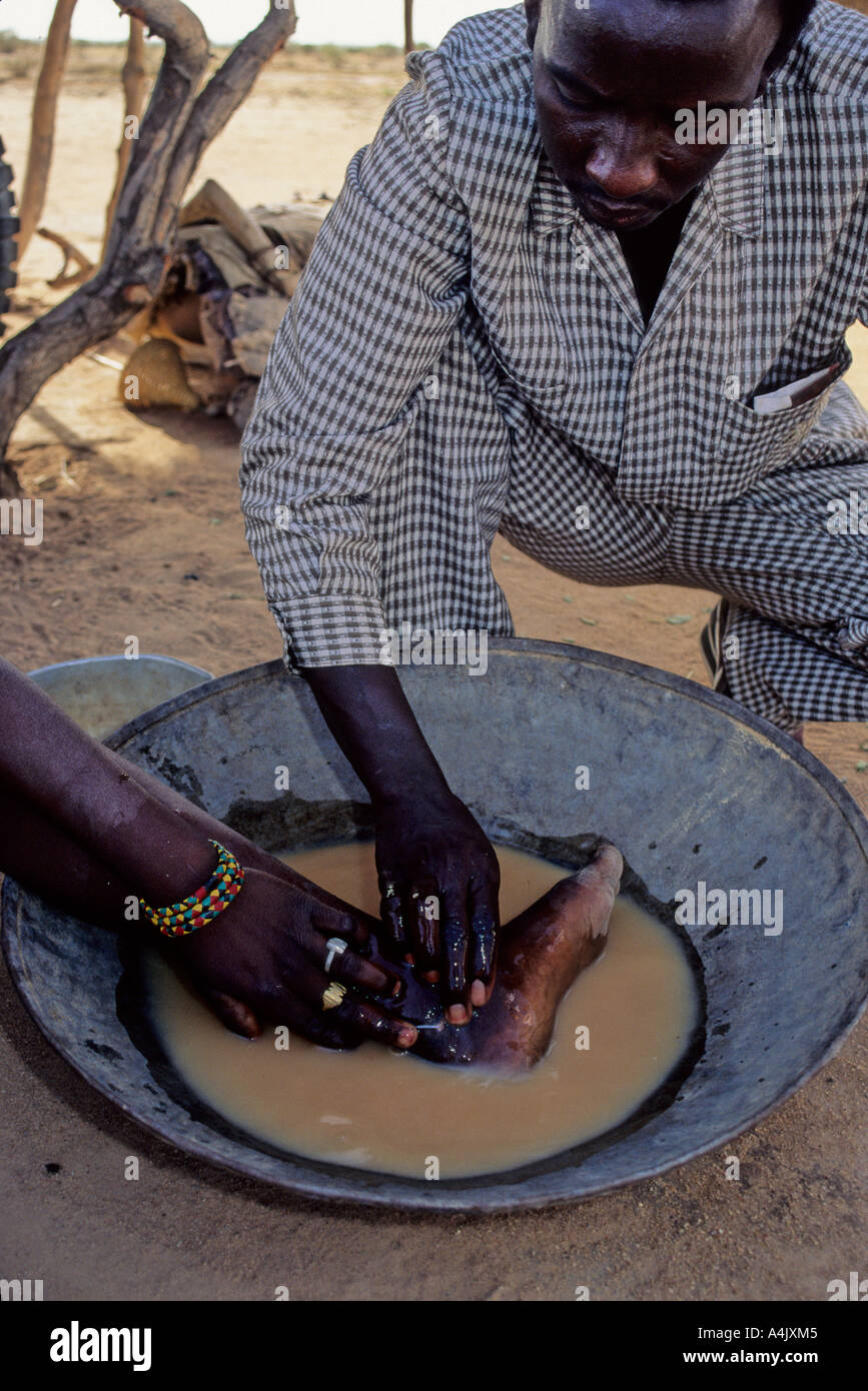 Guinea Worm Emerging.  Near Zinder, Niger. Stock Photo