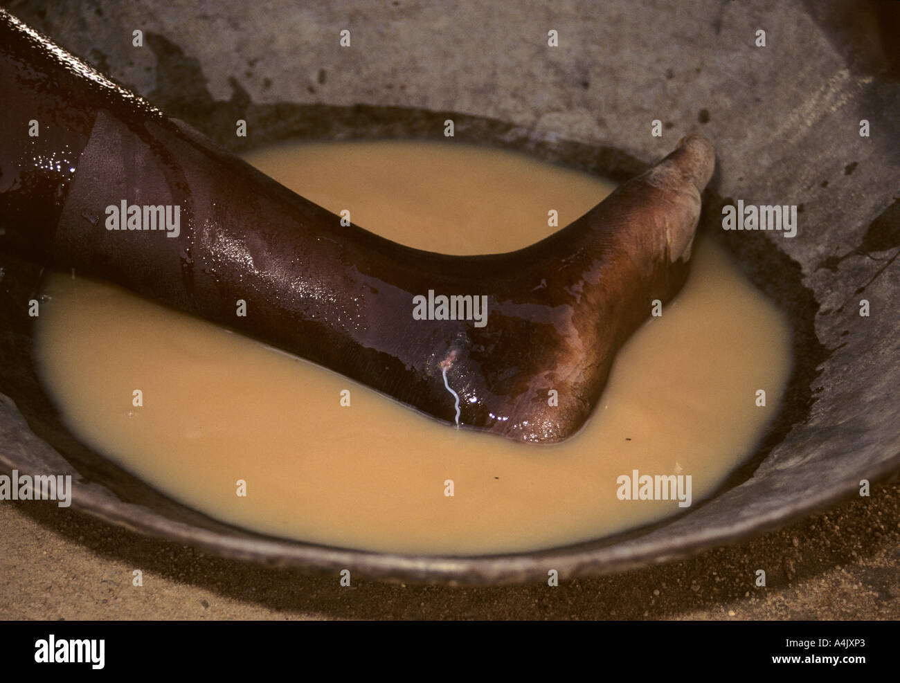 Guinea Worm Emerging. Stock Photo