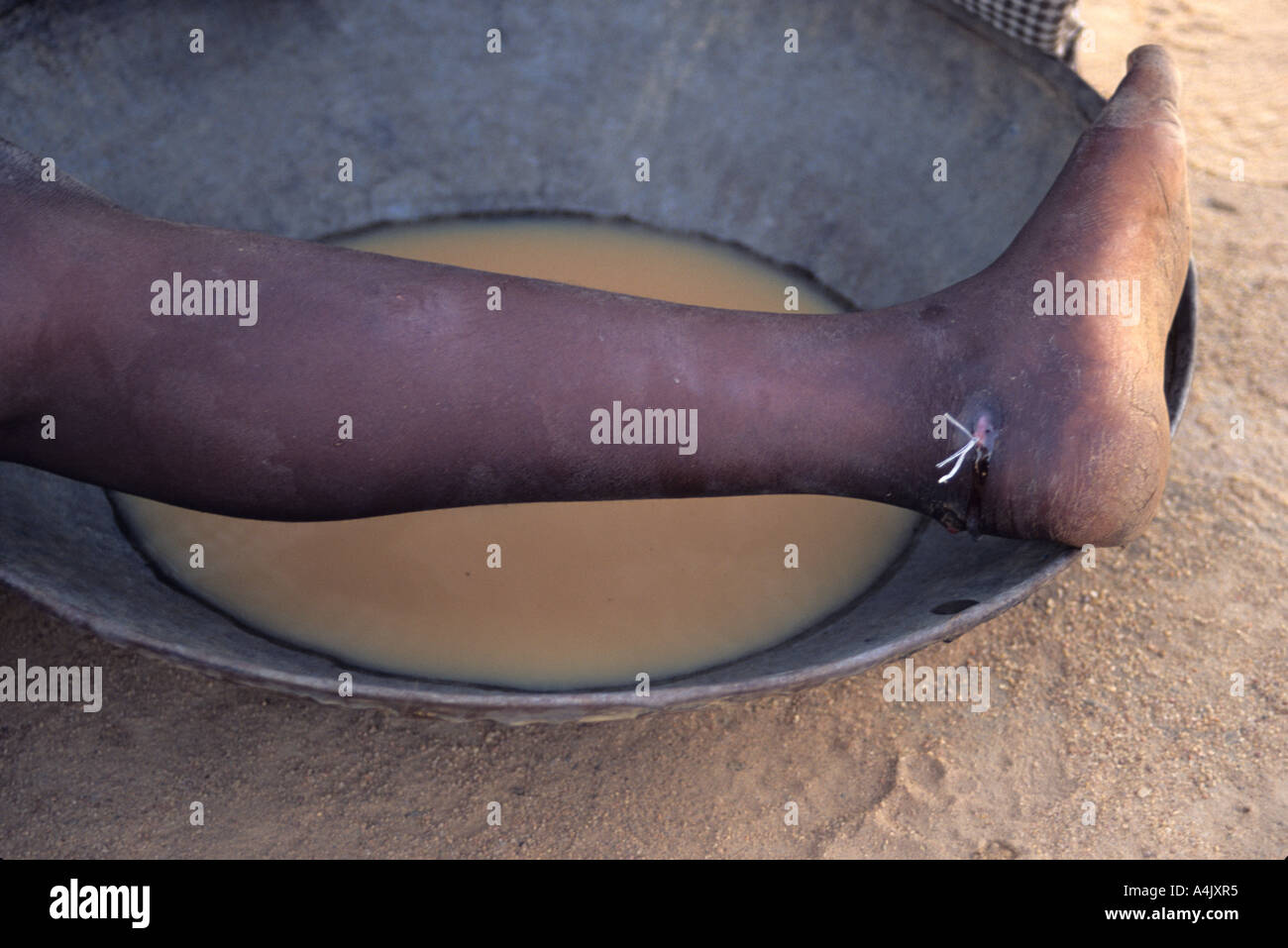 Guinea Worm Emerging.  Near Zinder, Niger. Stock Photo