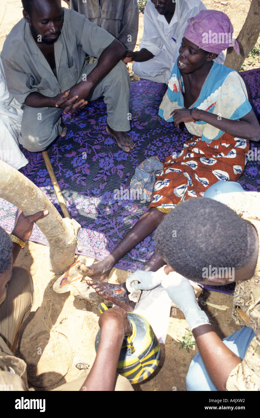 Treating Secondary Infection of Victim of Guinea Worm Infestation, Niger Stock Photo