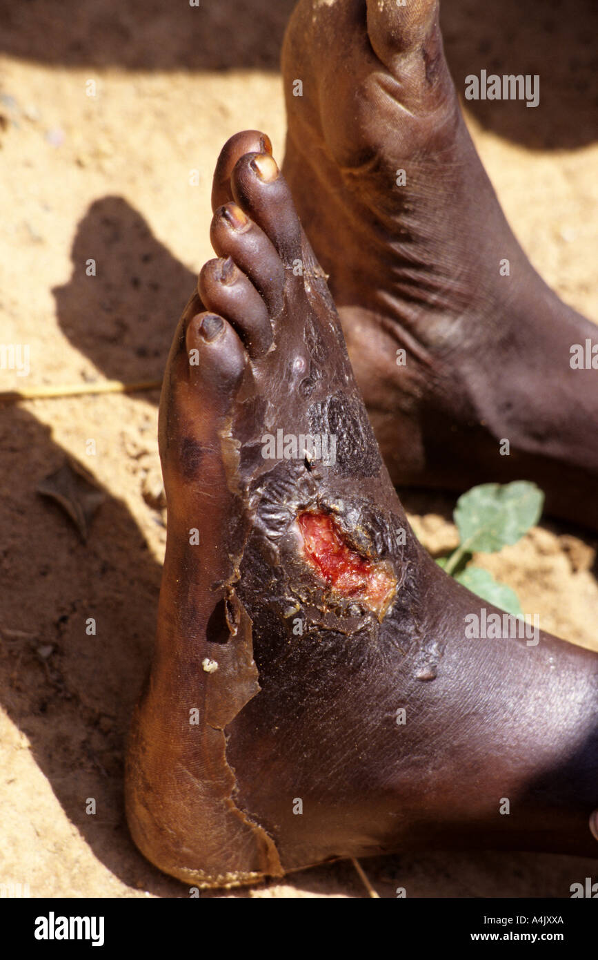 Secondary Infection Caused by Guinea Worm Wound, Niger Stock Photo