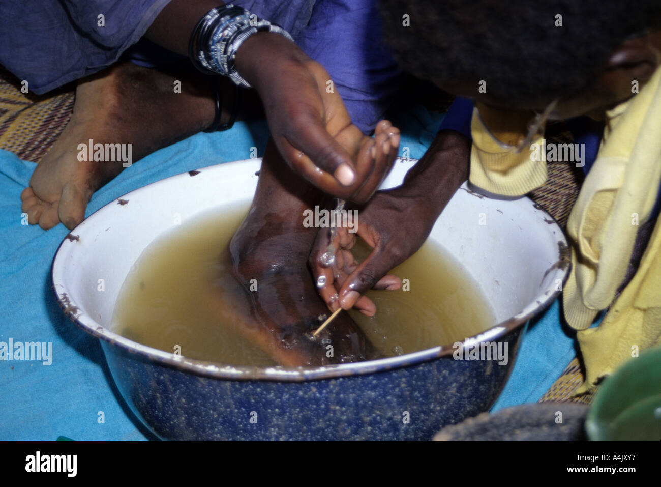Extracting Guinea Worm from Bella Woman, Niger Stock Photo