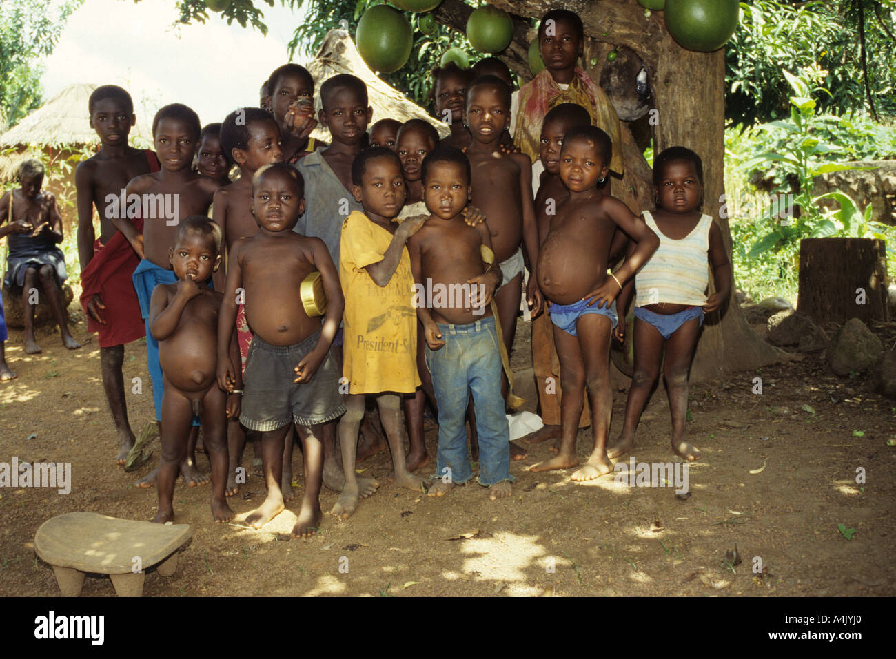 Kwashiorkor, malnutrition, intestinal parasites affect Senufo village boys in northern Ivory Coast. Stock Photo