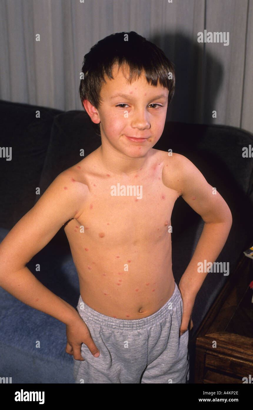 A child chicken pox hi-res stock photography and images - Alamy