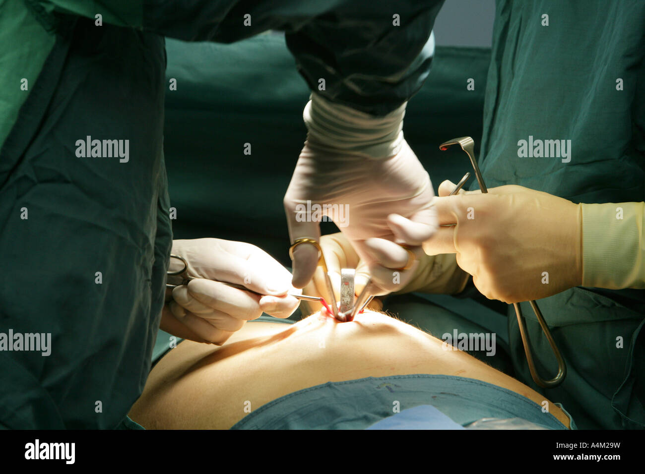 appendix operation