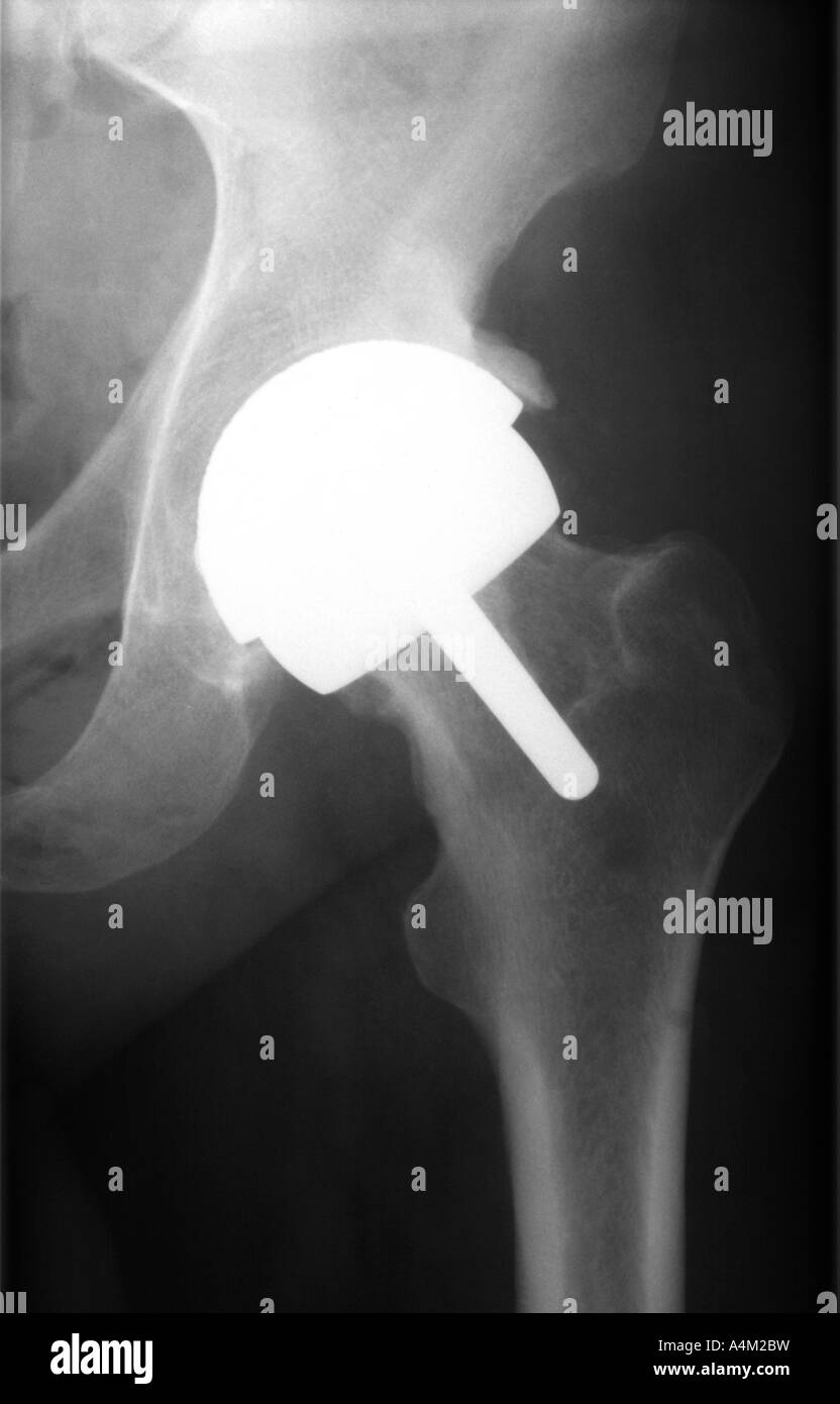 Birmingham hip replacement hires stock photography and images Alamy