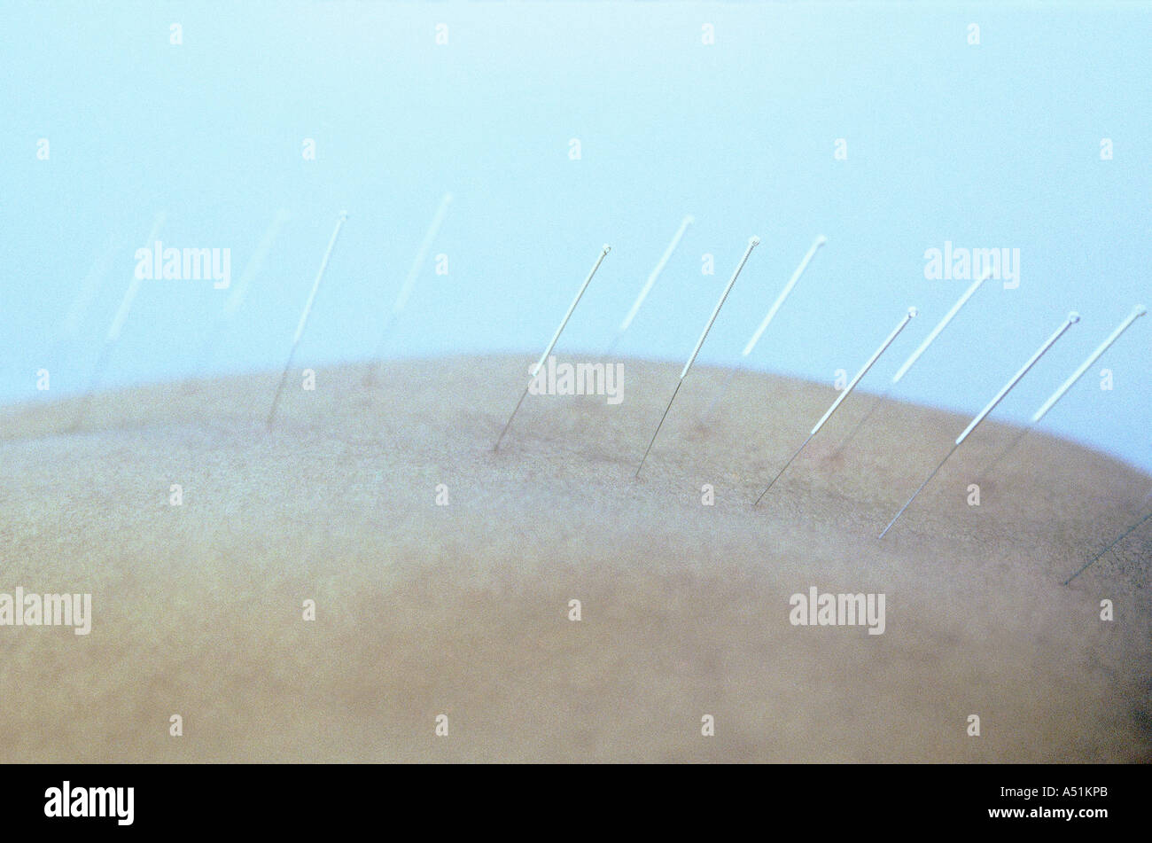 Acupuncture needles in womans back Stock Photo Alamy