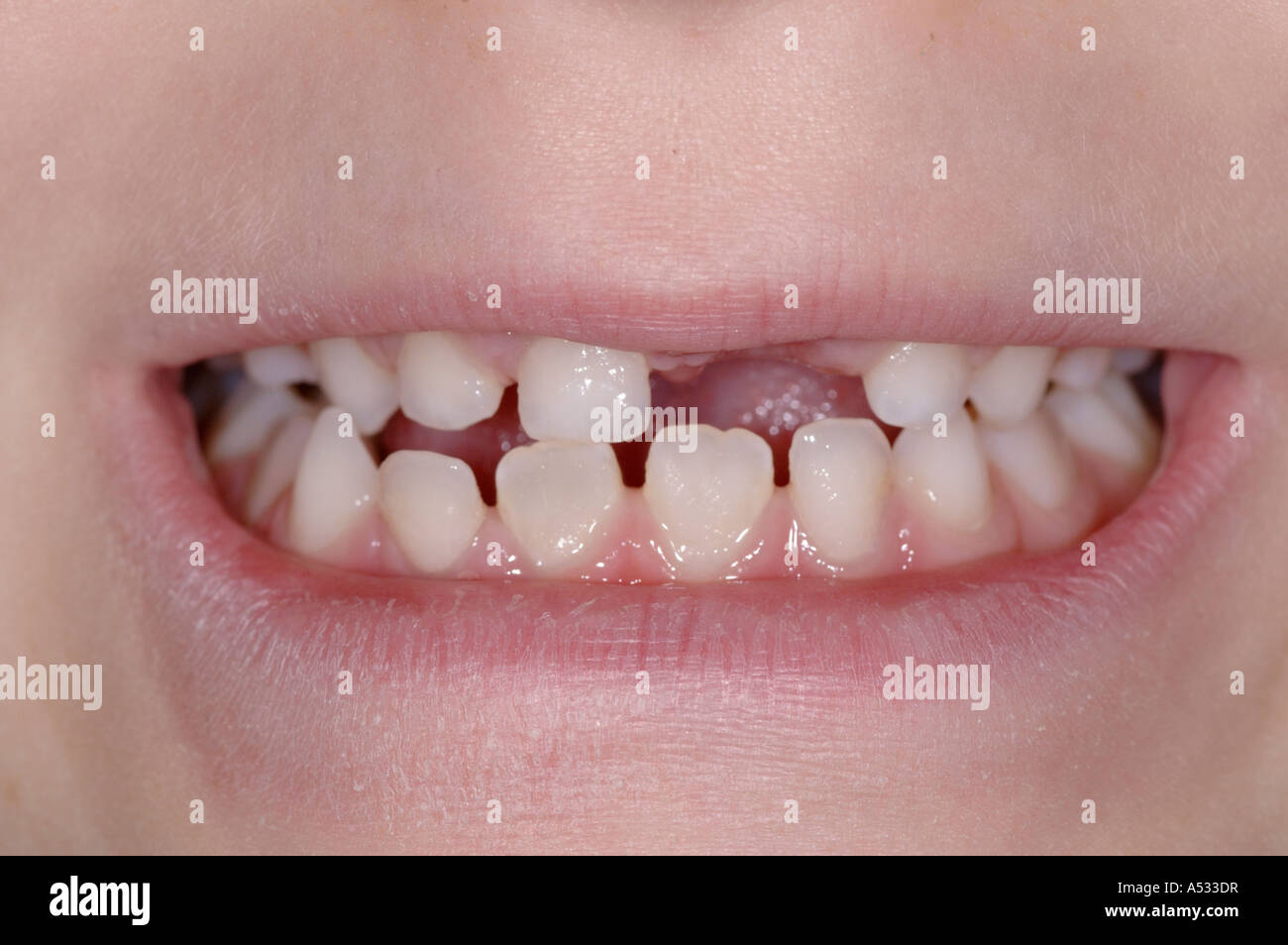 Smile with recently missing front tooth Stock Photo