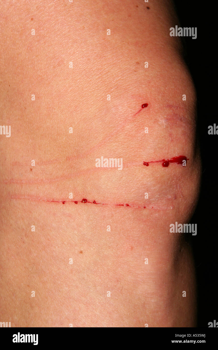 Cat scratch skin hi-res stock photography and images - Alamy