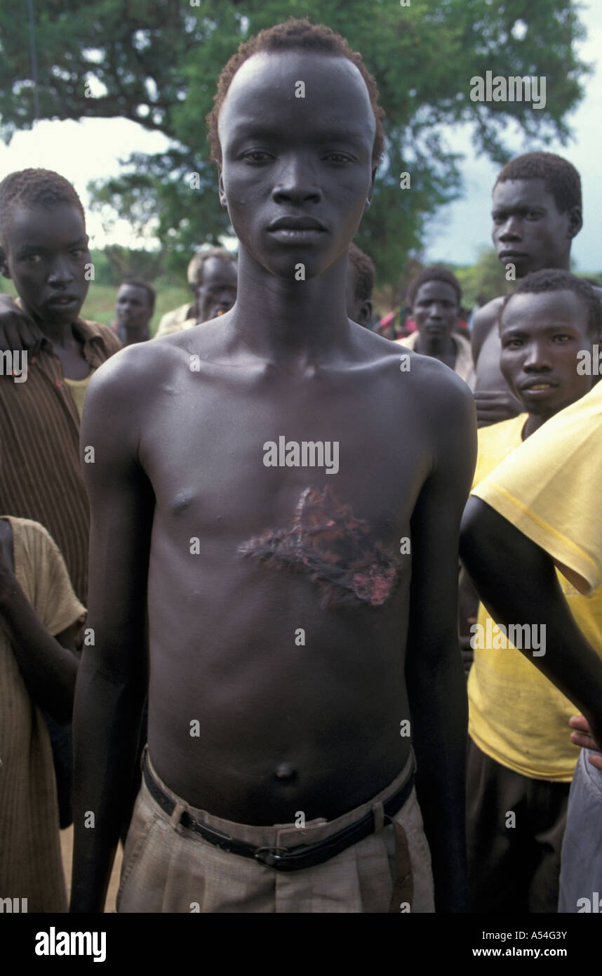 Painet hq1414 south sudan man badly scarred tortured by fire when refused convert islam nimule images torture war wounds Stock Photo