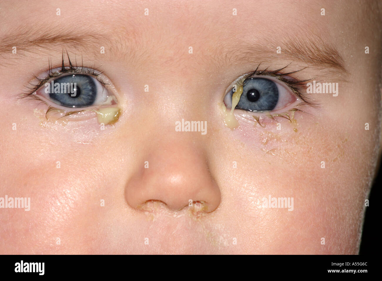 Baby suffering from conjunctivitis infection of the eye Stock Photo