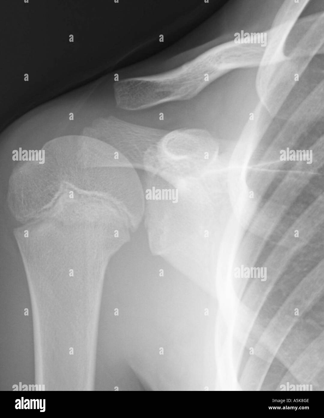 X Ray of young boys right shoulder Stock Photo Alamy