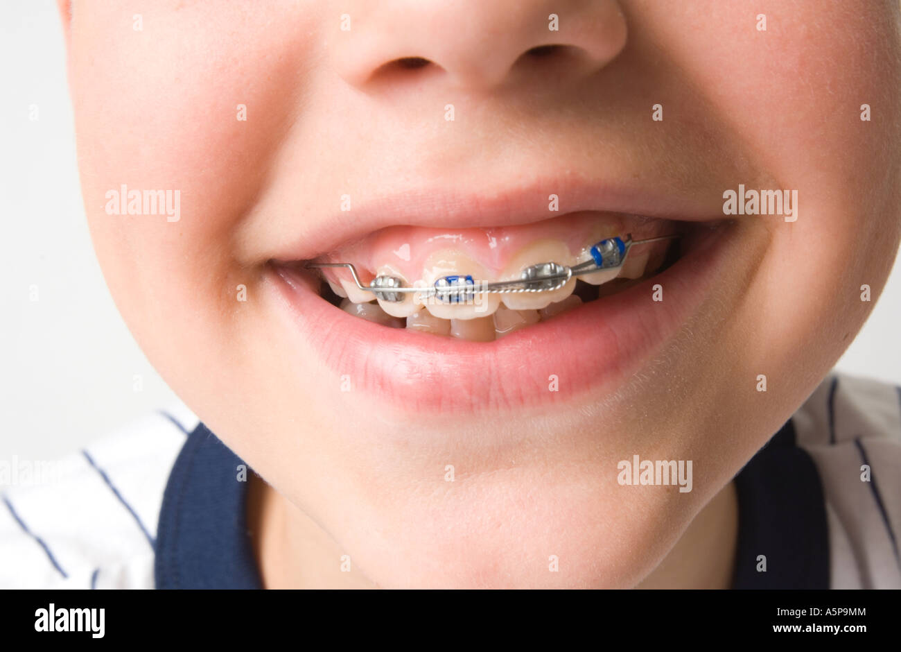 Smiling mouth, teeth with braces. Stock Photo