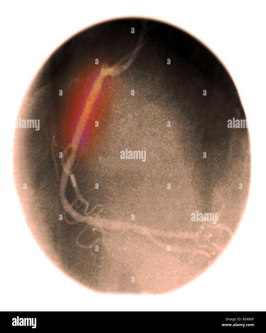 colorized xray of a coronary angiogram showing a stent placed in the right coronary artery to open an area of blockage  Stock Photo