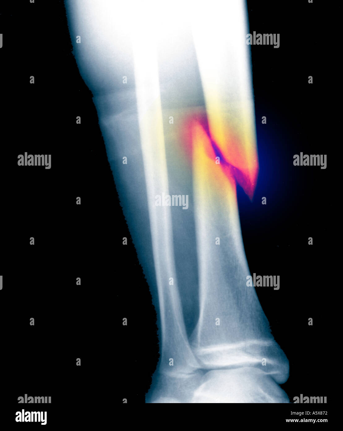 spiral fracture of midshaft tibia Stock Photo Alamy