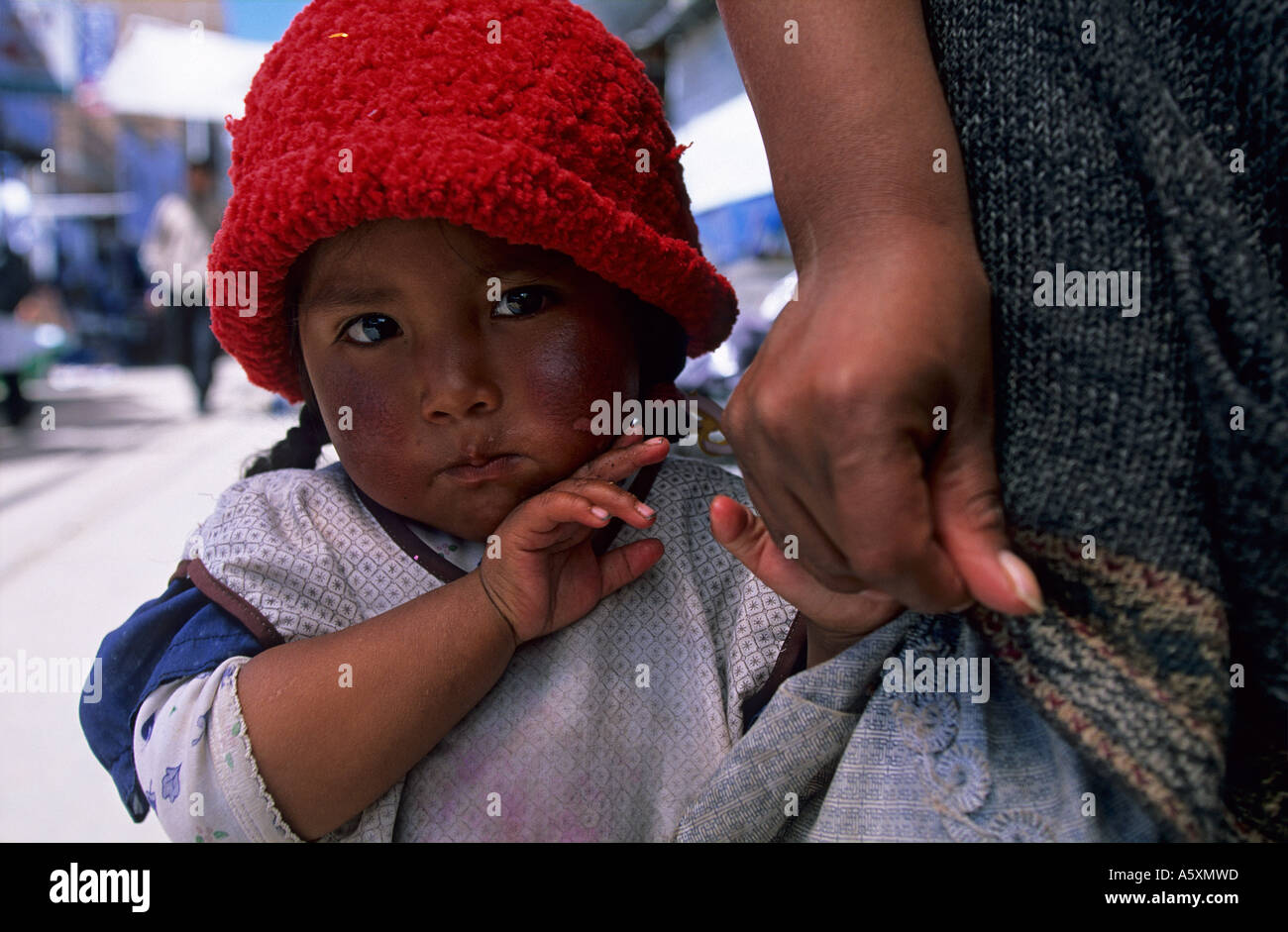 A young sulky girl with first-degree burns on the face. Puno (Peru). Fillette boudeuse au visage brûlé. Puno (Pérou). Portrait. Stock Photo
