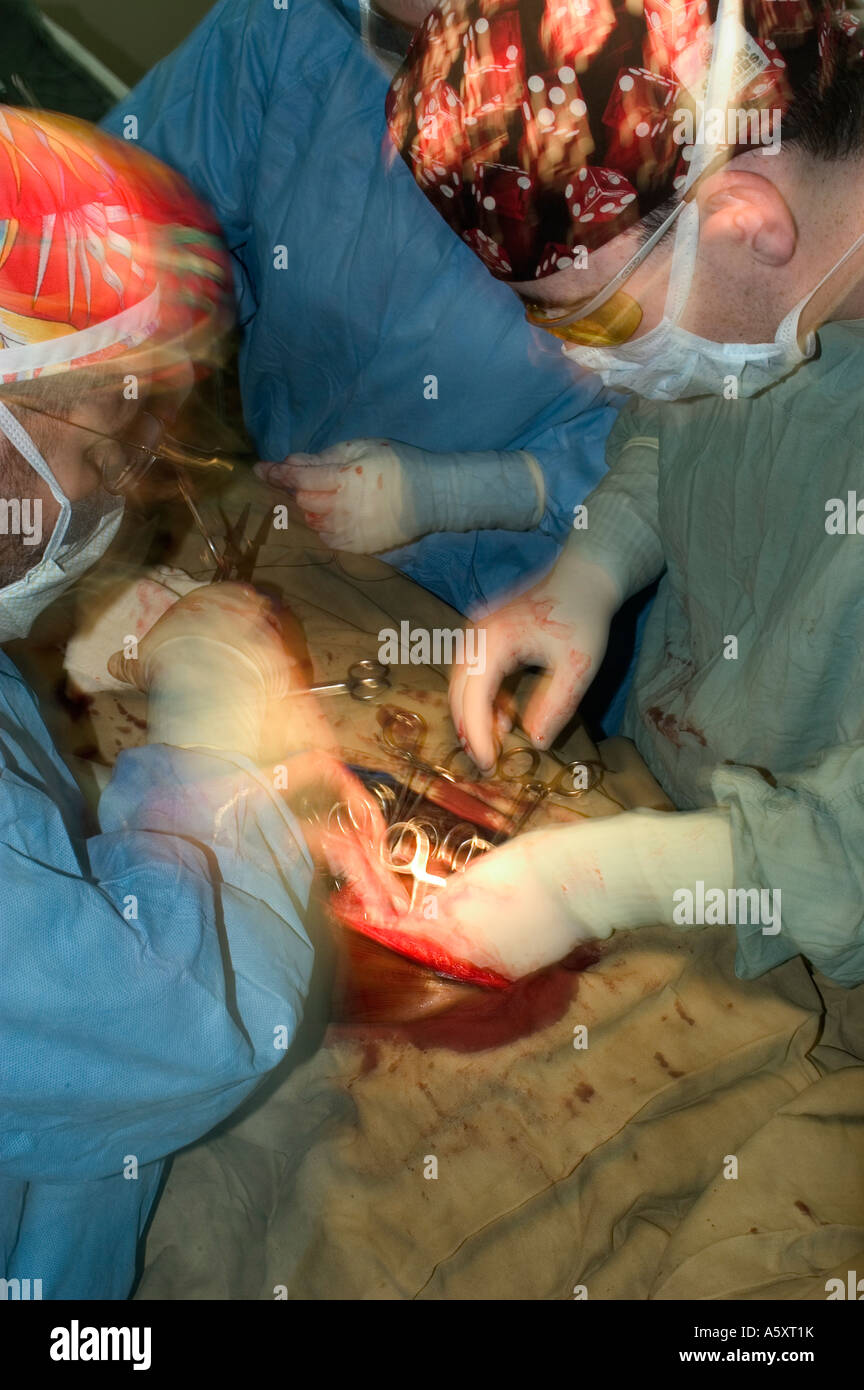 action shot showing volunteer surgeons in Nigeria operating to remove a large abdominal tumor during surgery on a patient Stock Photo