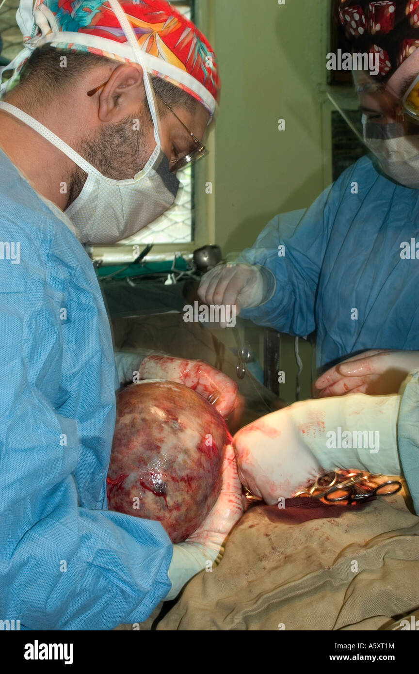 volunteer surgeons in Nigeria removing a large abdominal tumor during surgery on a patient Stock Photo