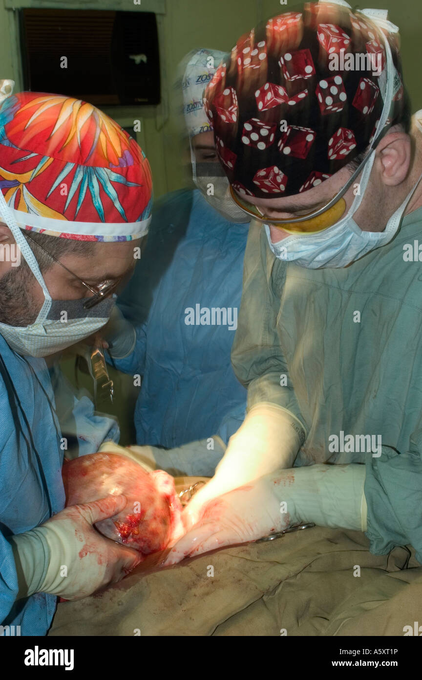 volunteer surgeons in Nigeria removing a large abdominal tumor during surgery on a patient Stock Photo