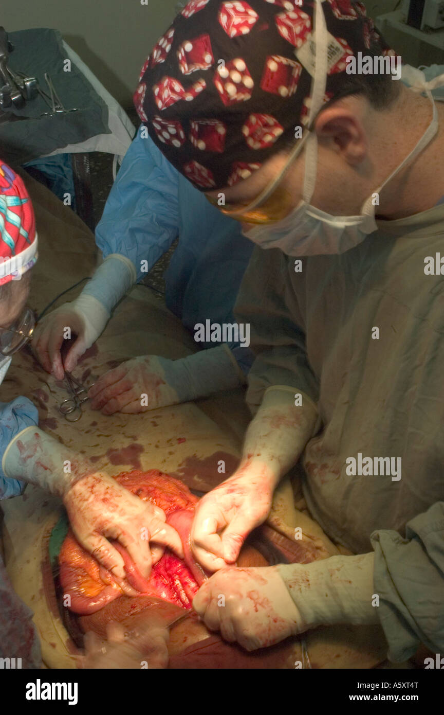 Volunteer surgeons in Nigeria operating to remove a large abdominal tumor during surgery on a patient Stock Photo
