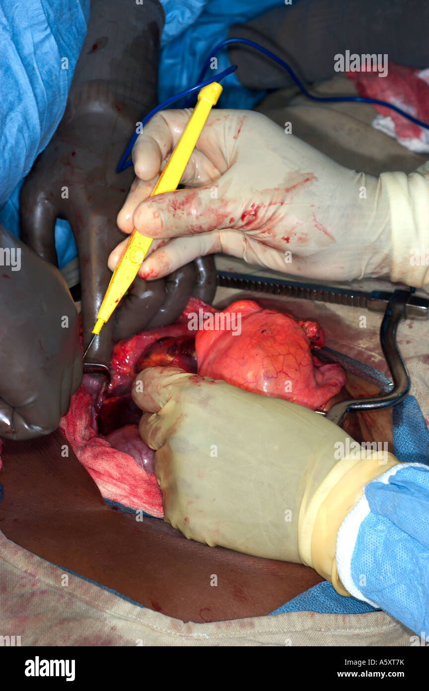 abdominal surgery in Nigeria Stock Photo