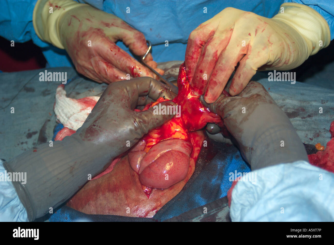 abdominal surgery in Nigeria Stock Photo