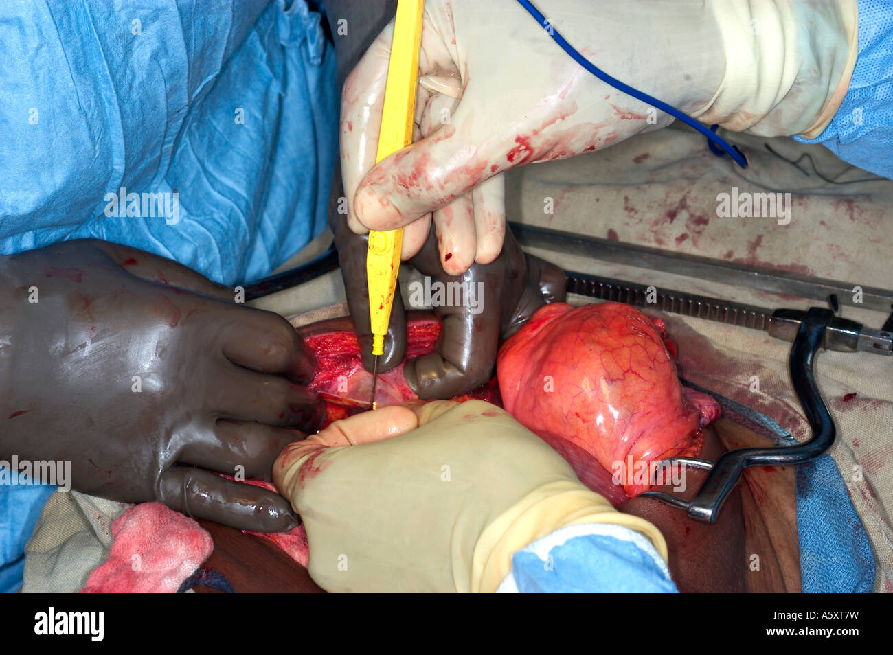 abdominal surgery in Nigeria Stock Photo