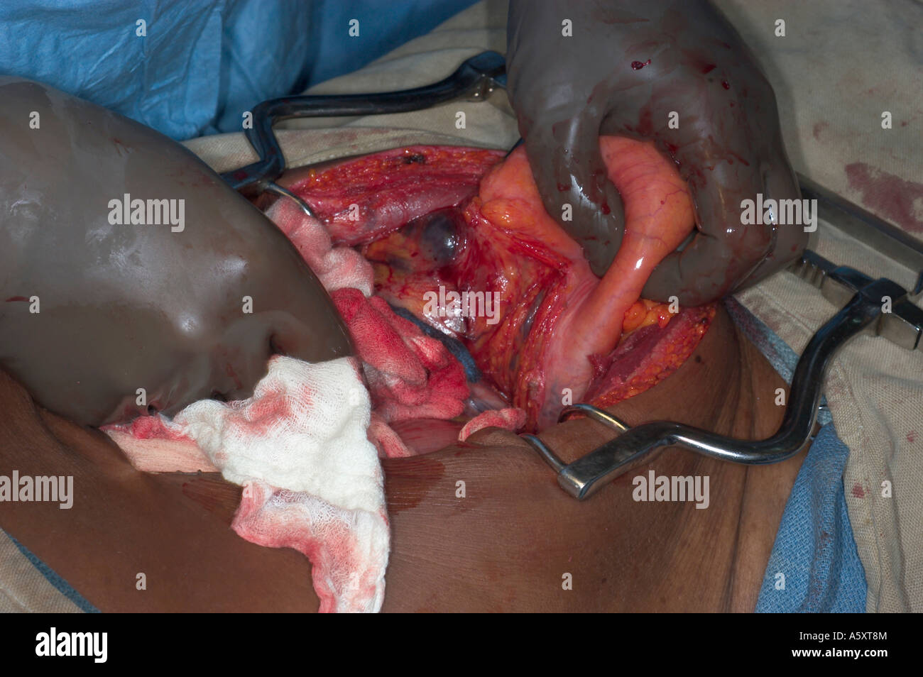 abdominal surgery in Nigeria Stock Photo