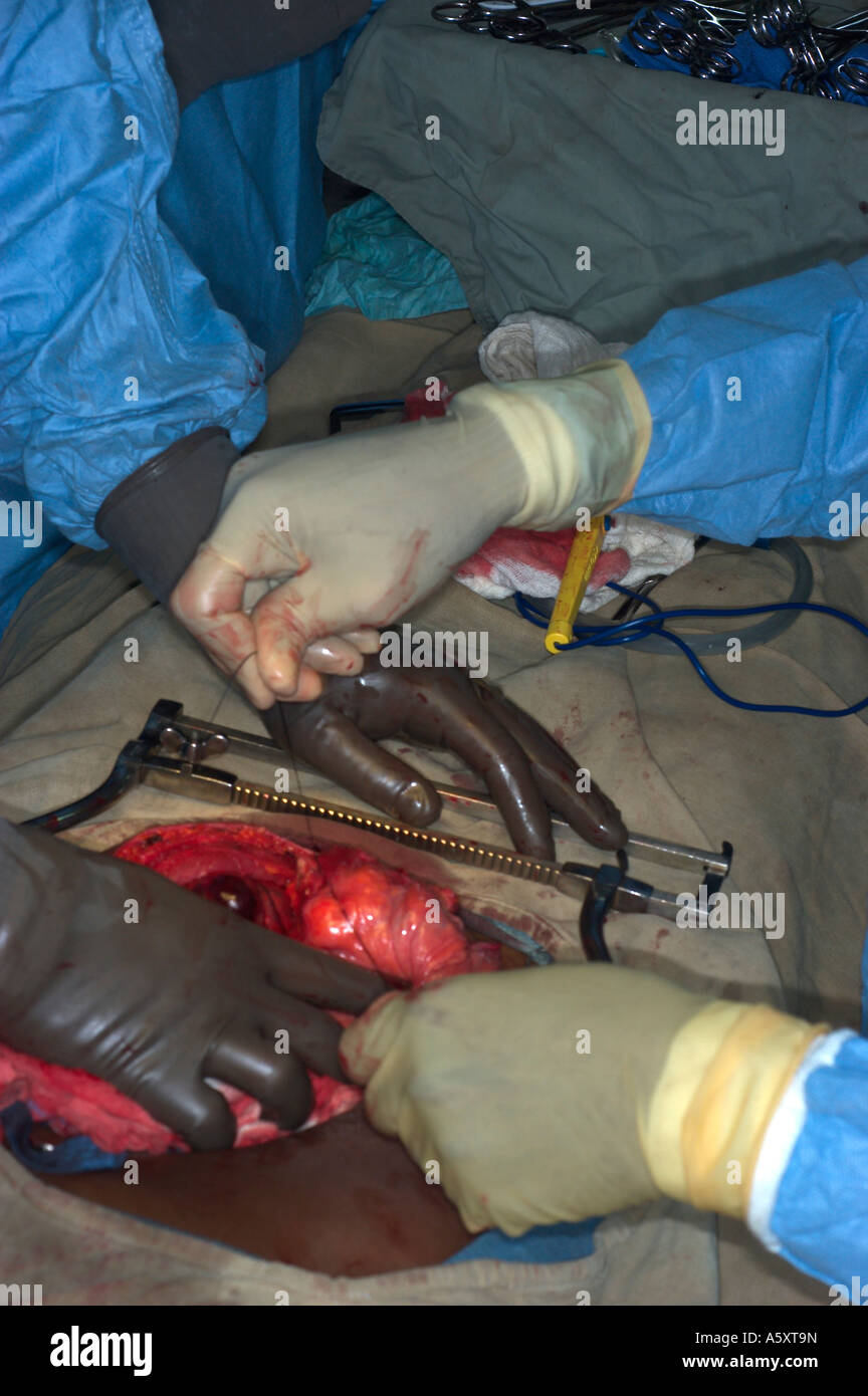 abdominal surgery in Nigeria Stock Photo