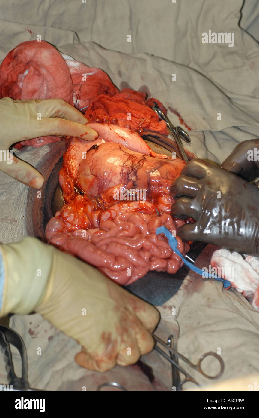 abdominal surgery in Nigeria Stock Photo
