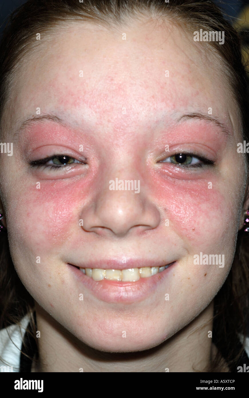 skin rash of contact dermatitis on the face of a 16 year old girl Stock Photo