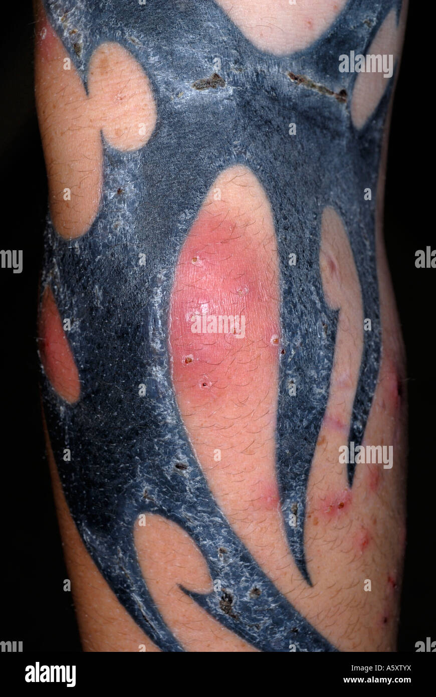 Tattoo Staph Infection