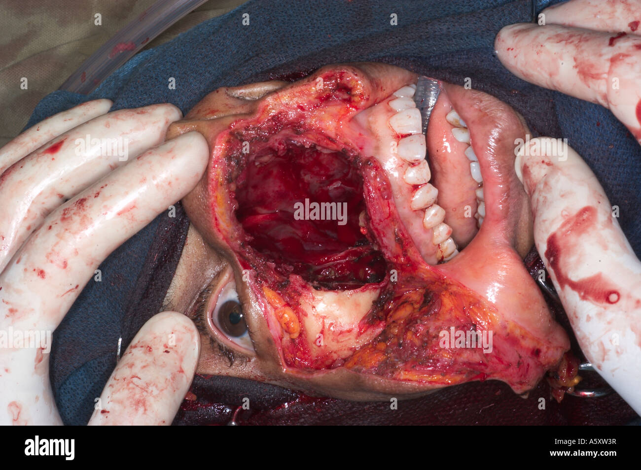surgery to remove a maxillary tumor in a Nigerian patient Stock Photo