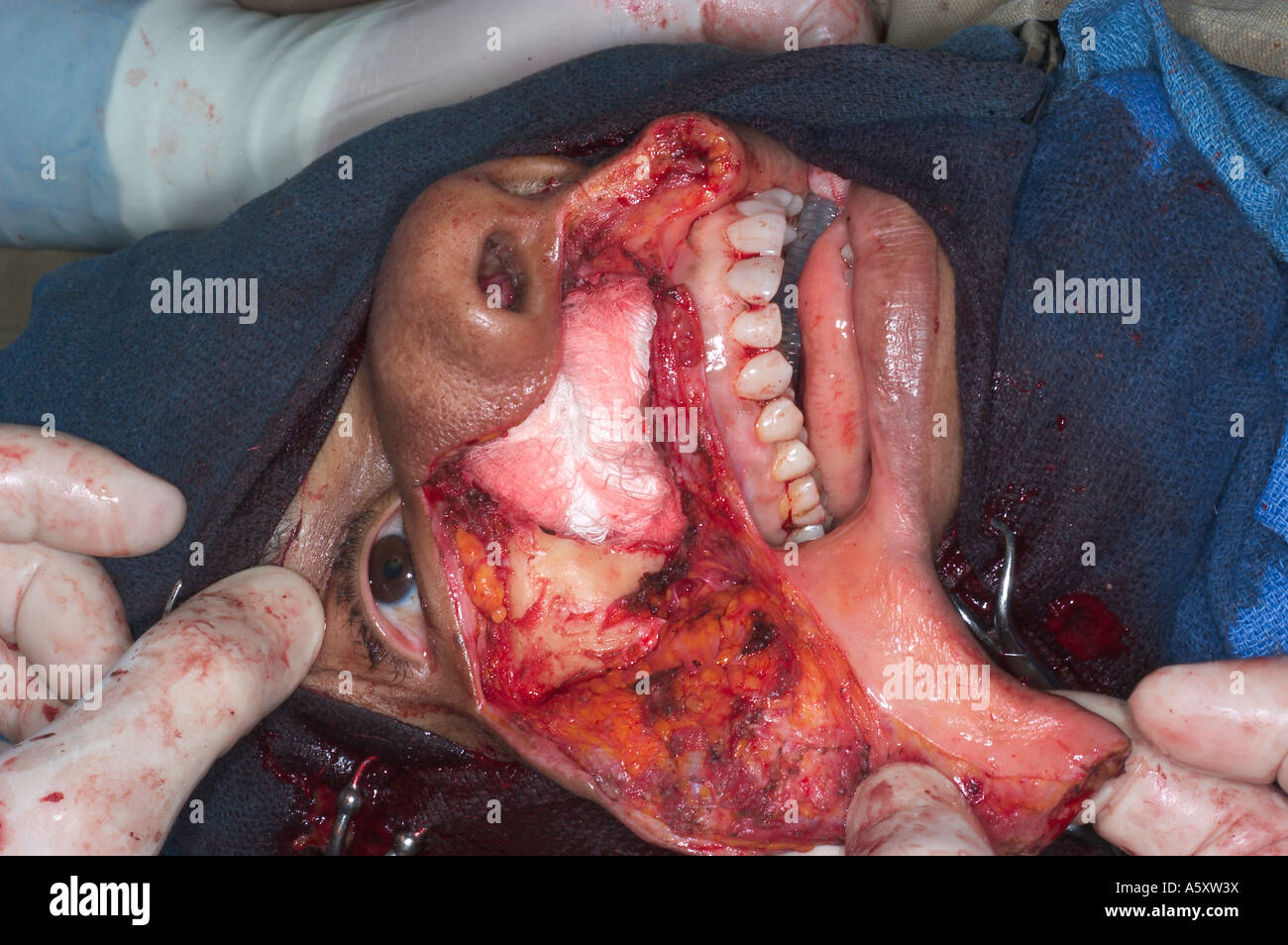 surgery to remove a maxillary tumor in a Nigerian patient Stock Photo