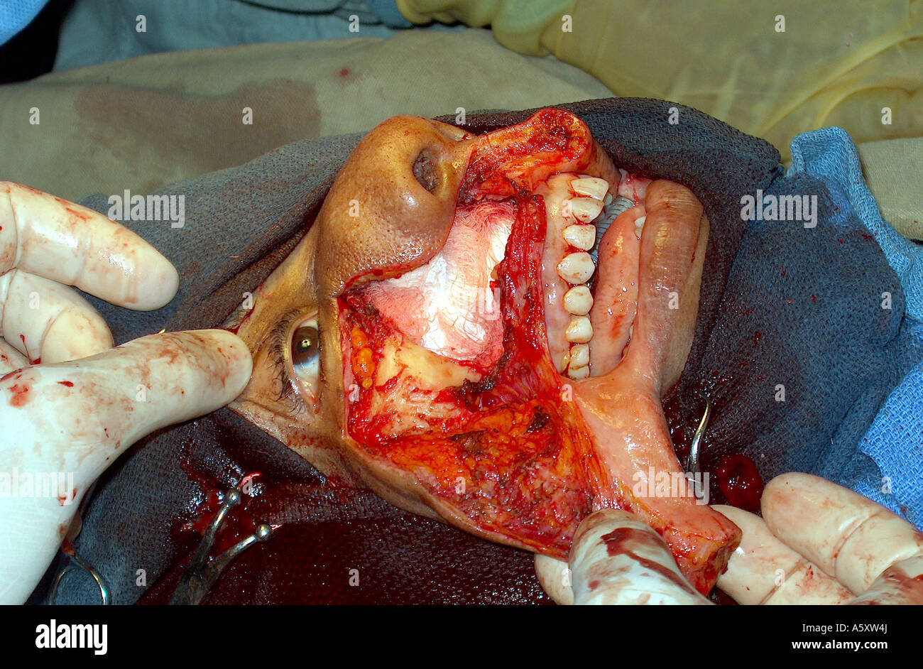 surgery for the removal of a facial tumor in a Nigerian patient Stock Photo