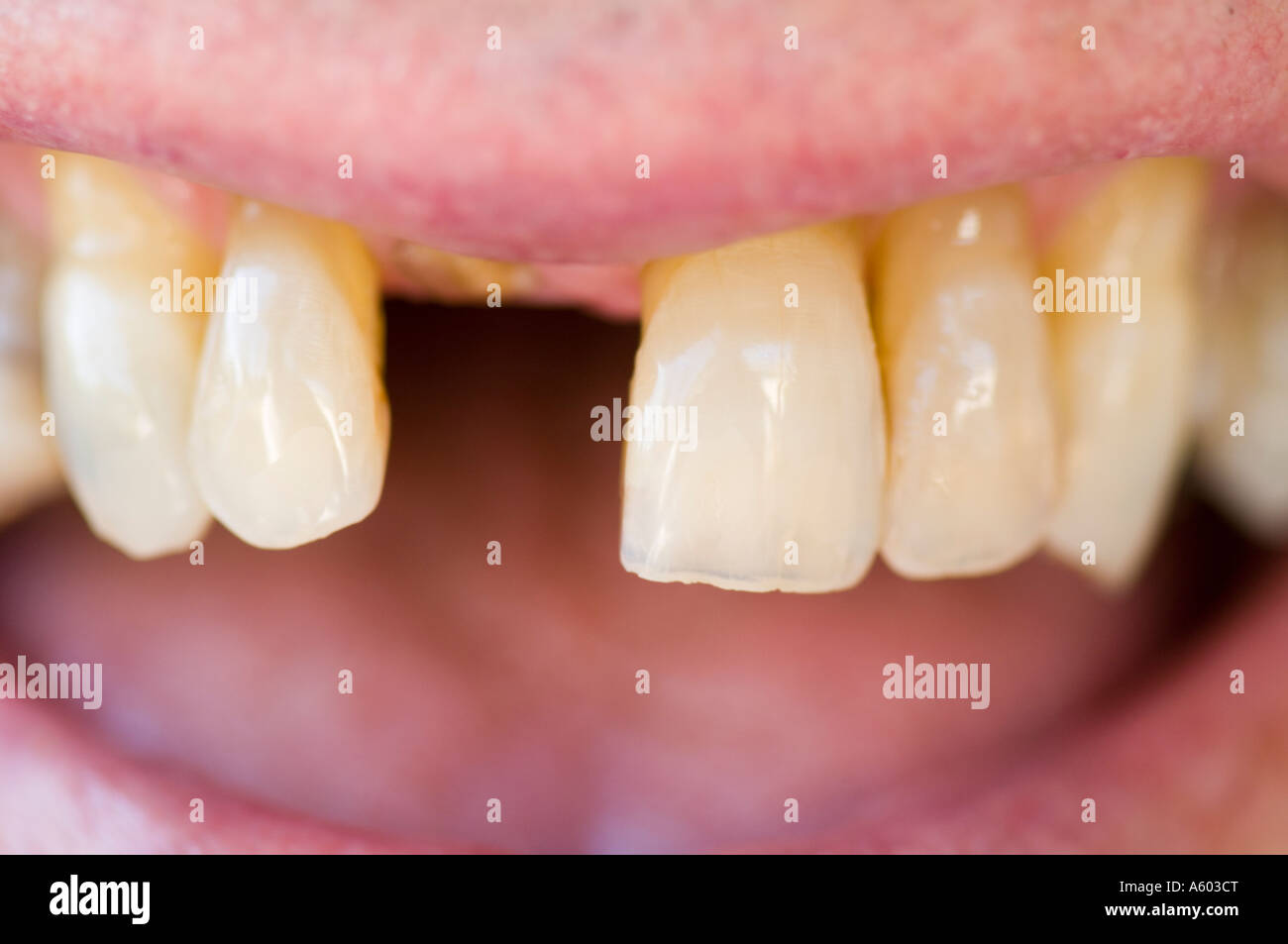 closeup of missing tooth on old man Stock Photo