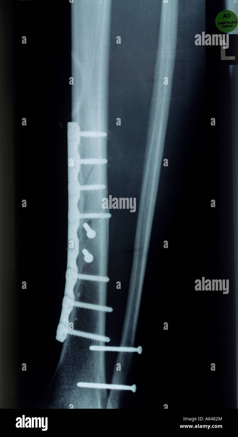 xray of a broken shinbone inseted by metal plate and screws Stock Photo