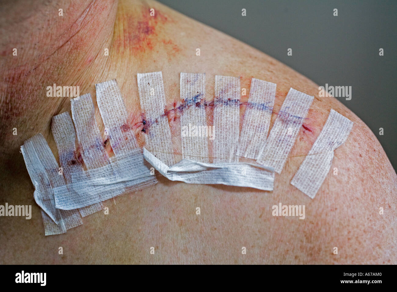 An incision covered by steri strips following surgery to repair a broken collarbone Stock Photo