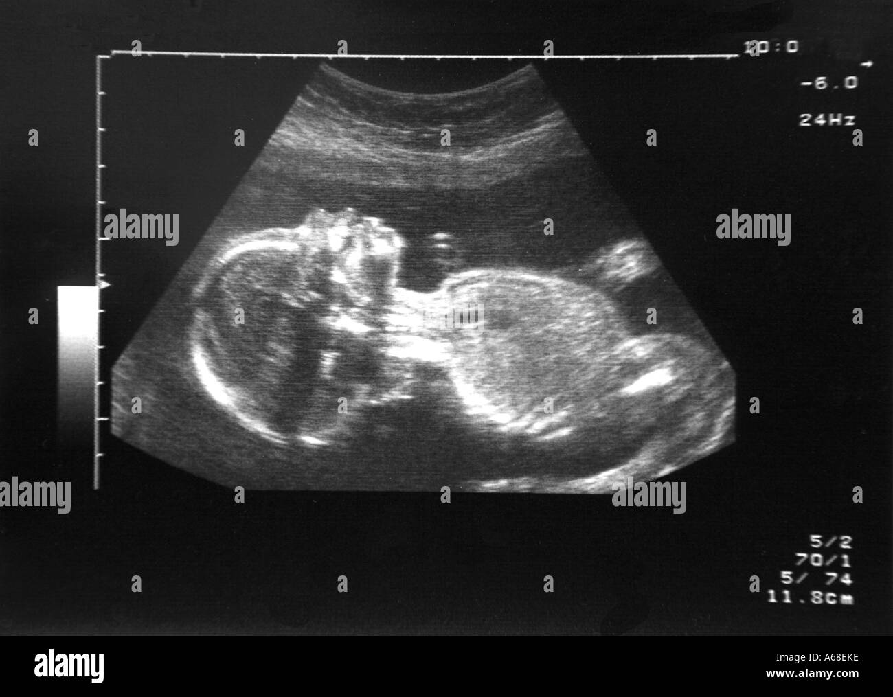 Twenty week ultrasound scan of a healthy foetus Stock Photo