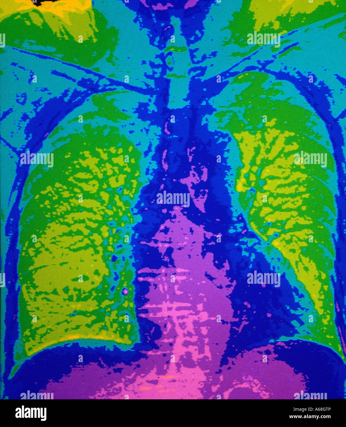 CT scan of chest and lung Stock Photo