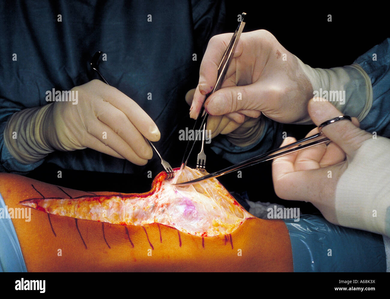 Knee reconstructive surgery Stock Photo