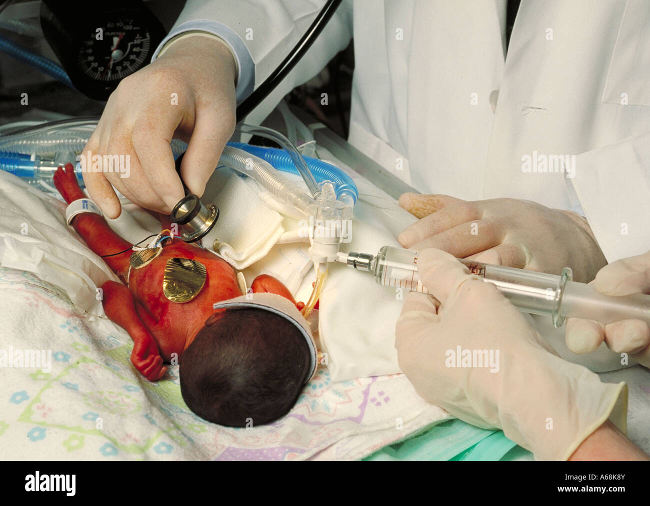 Premature infant Stock Photo