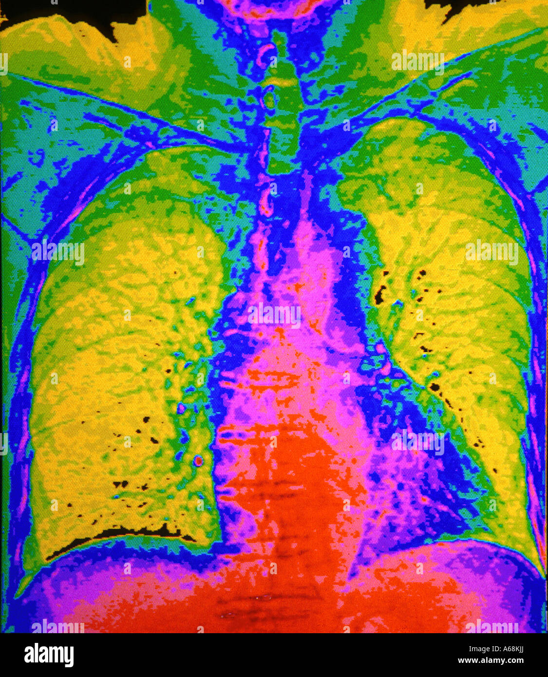 CT scan of chest and lung Stock Photo