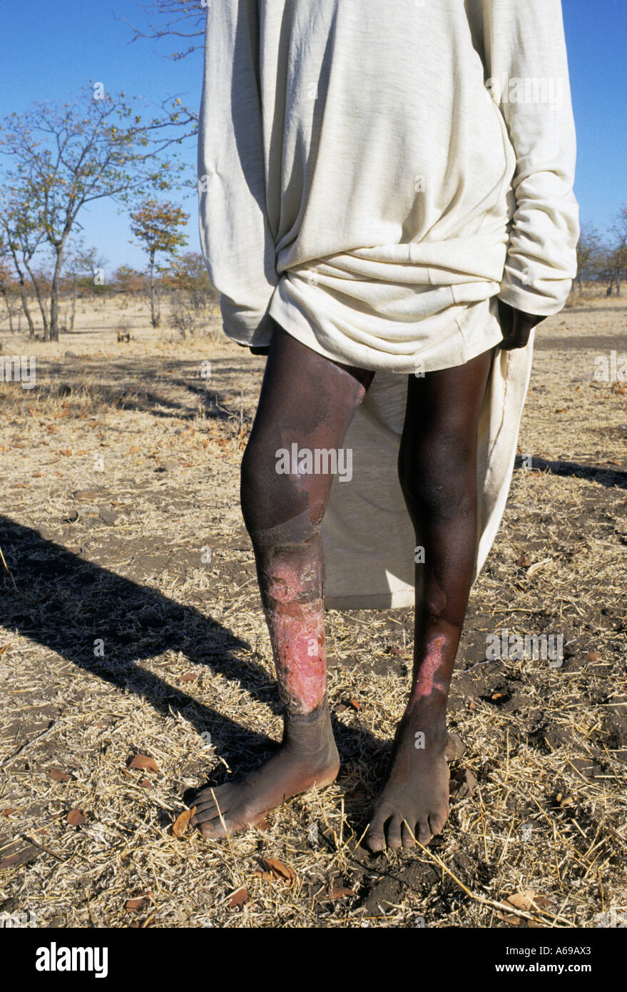 young boy with burns on his legs from falling into a fire. Zimbabwe, Africa Stock Photo
