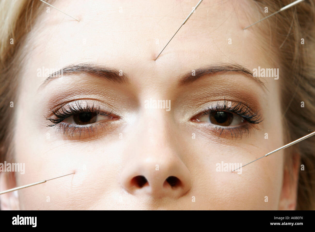 Women receiving acupuncture treatment Stock Photo