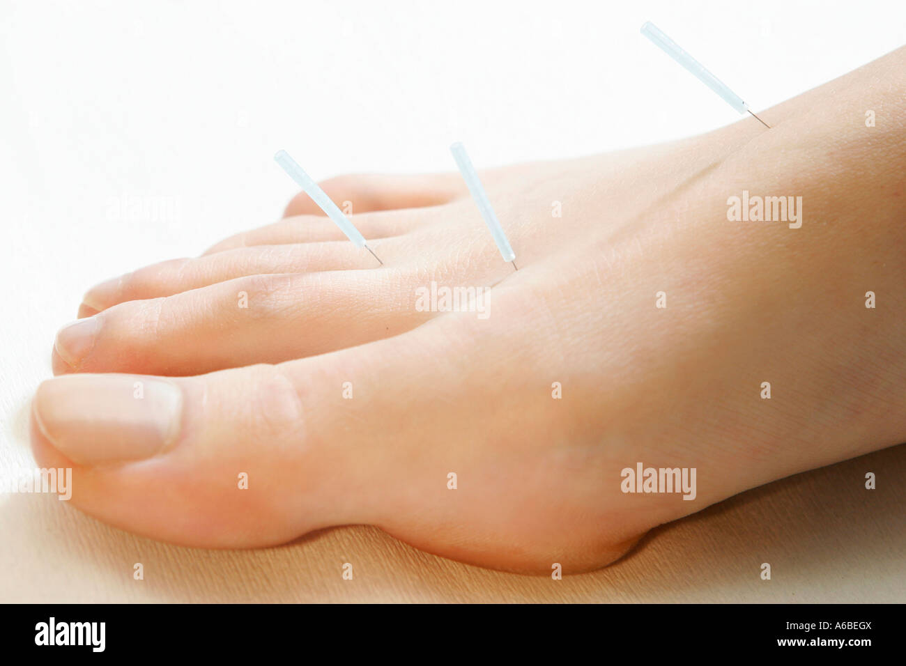 Women receiving acupuncture treatment Stock Photo
